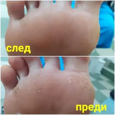 Медицински педикюр - гр.Ямбол Pedi-Cure