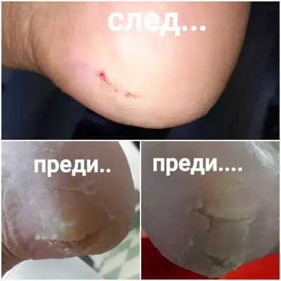 Медицински педикюр - гр.Ямбол Pedi-Cure
