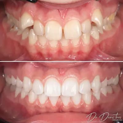 Д-р Димитър Димитров - Ортодонтия | Брекети | Invisalign Алайнери | Пловдив