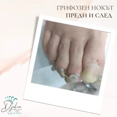 Терапевтичен педикюр