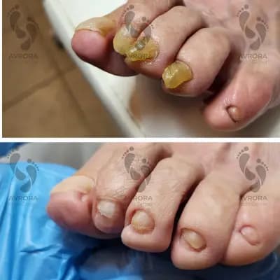 Терапевтичен/медицински педикюр и подология "Аврора Подо"