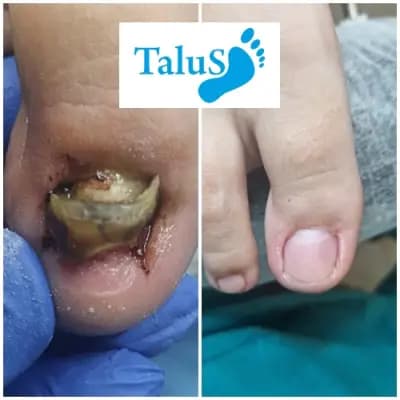 Медицински педикюр-подолог Варна "Talus"