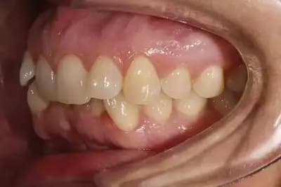 Невидими Брекети - Invisible Braces