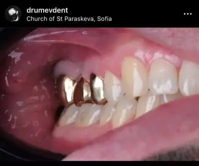 DrumevDent