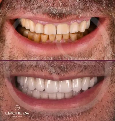 Д-р Ваня Липчева - Пародонтология | Имплантология | Естетика | Dr. Vanya Lipcheva - Periodontology | Implantology |