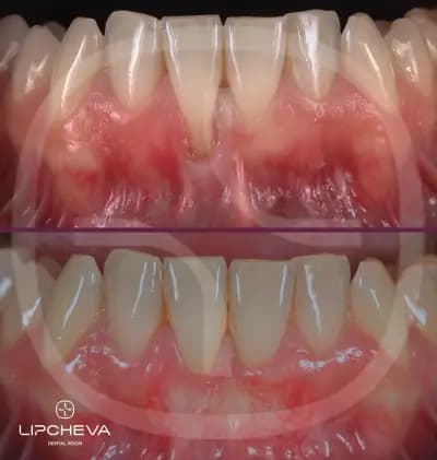 Д-р Ваня Липчева - Пародонтология | Имплантология | Естетика | Dr. Vanya Lipcheva - Periodontology | Implantology |