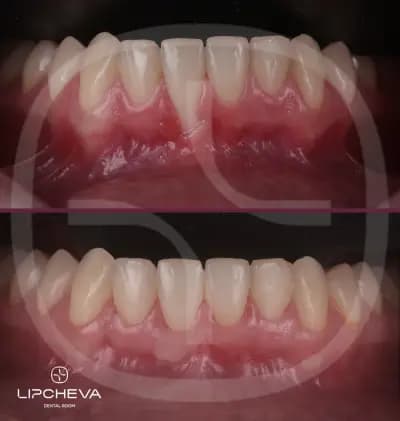 Д-р Ваня Липчева - Пародонтология | Имплантология | Естетика | Dr. Vanya Lipcheva - Periodontology | Implantology |