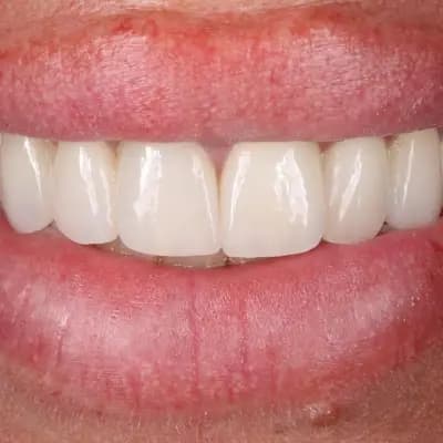 Д-р Ваня Липчева - Пародонтология | Имплантология | Естетика | Dr. Vanya Lipcheva - Periodontology | Implantology |