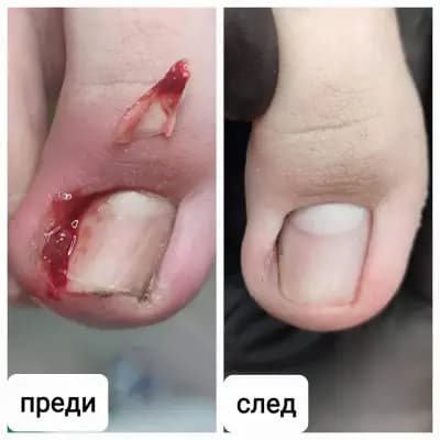 Медицински педикюр в Силистра