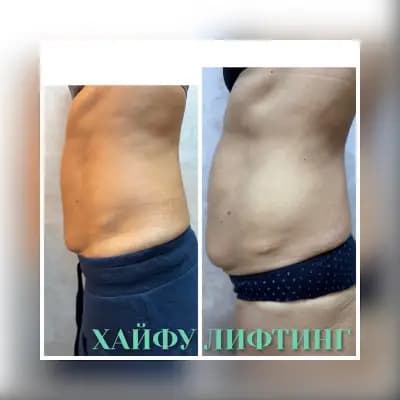Body correction Varna 2