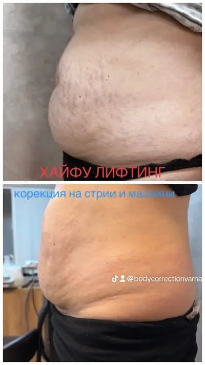 Body correction Varna 2