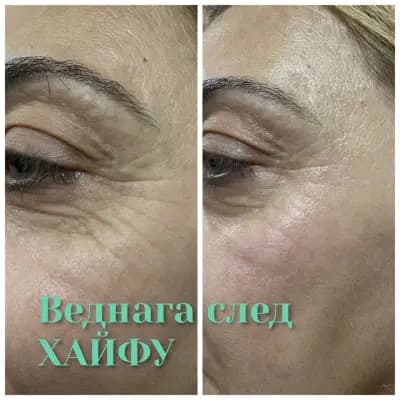 Body correction Varna 2