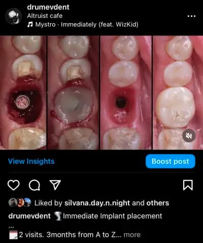 DrumevDent