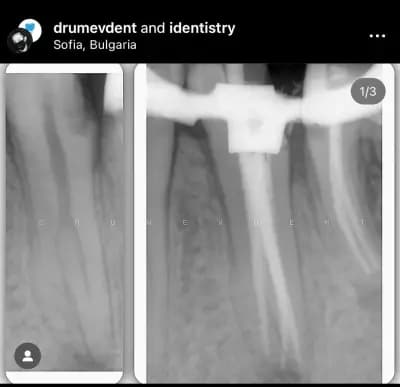DrumevDent