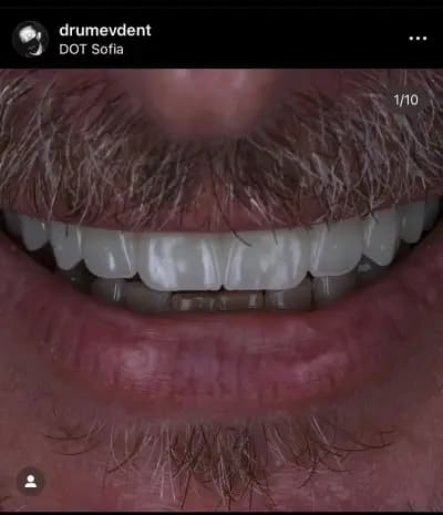 DrumevDent